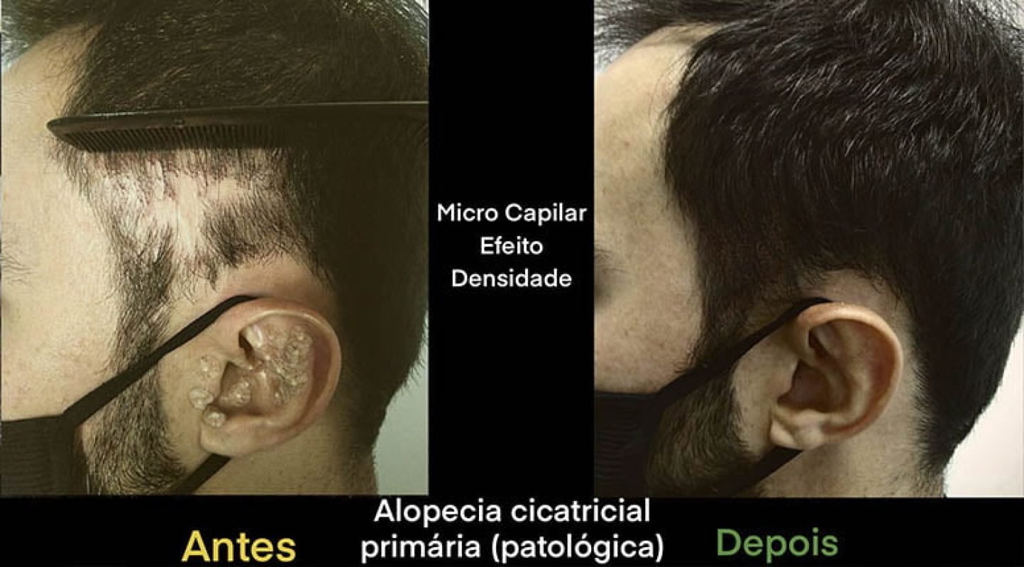 Micro-Pigmentacao-cicatricial-