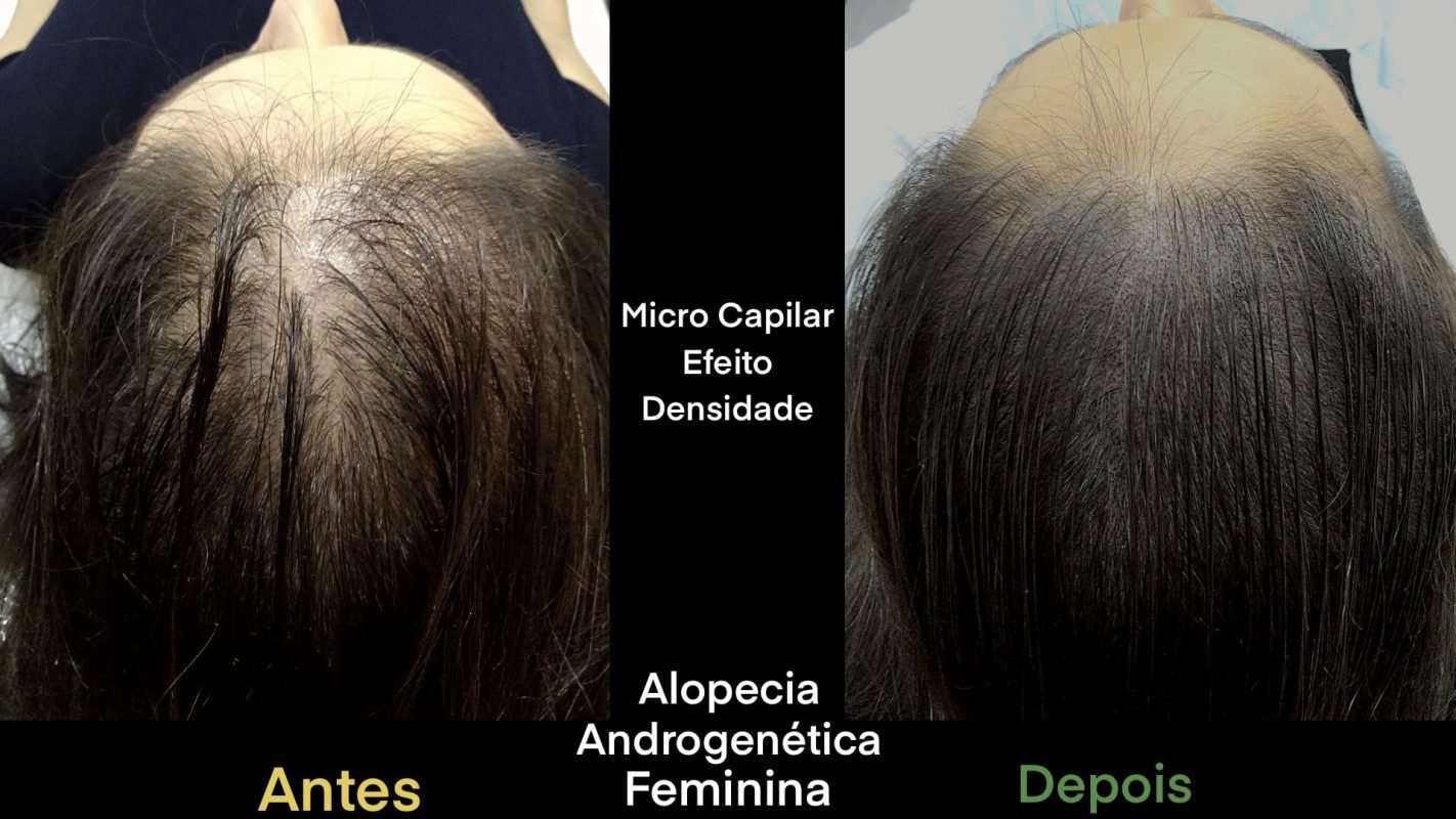 Micro-capilar-Alopecia-Androgenetica-Feminina